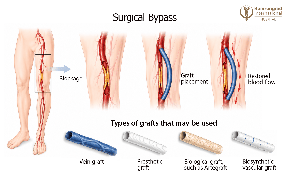 Endovascular-and-Surgical-Revascularization-for-Non-Healing-Wounds-image-2.png