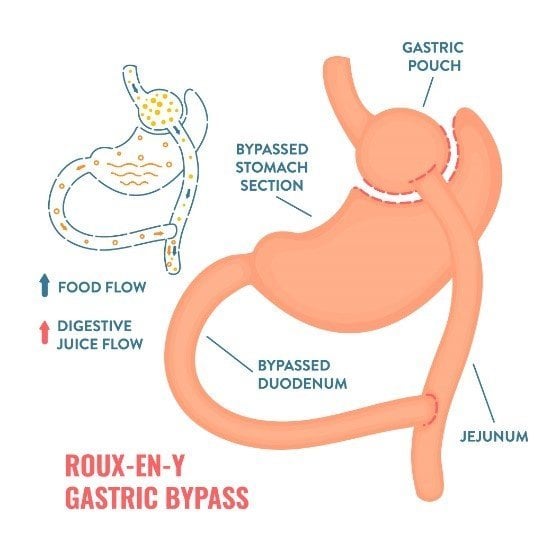 Gastric-bypass.jpg