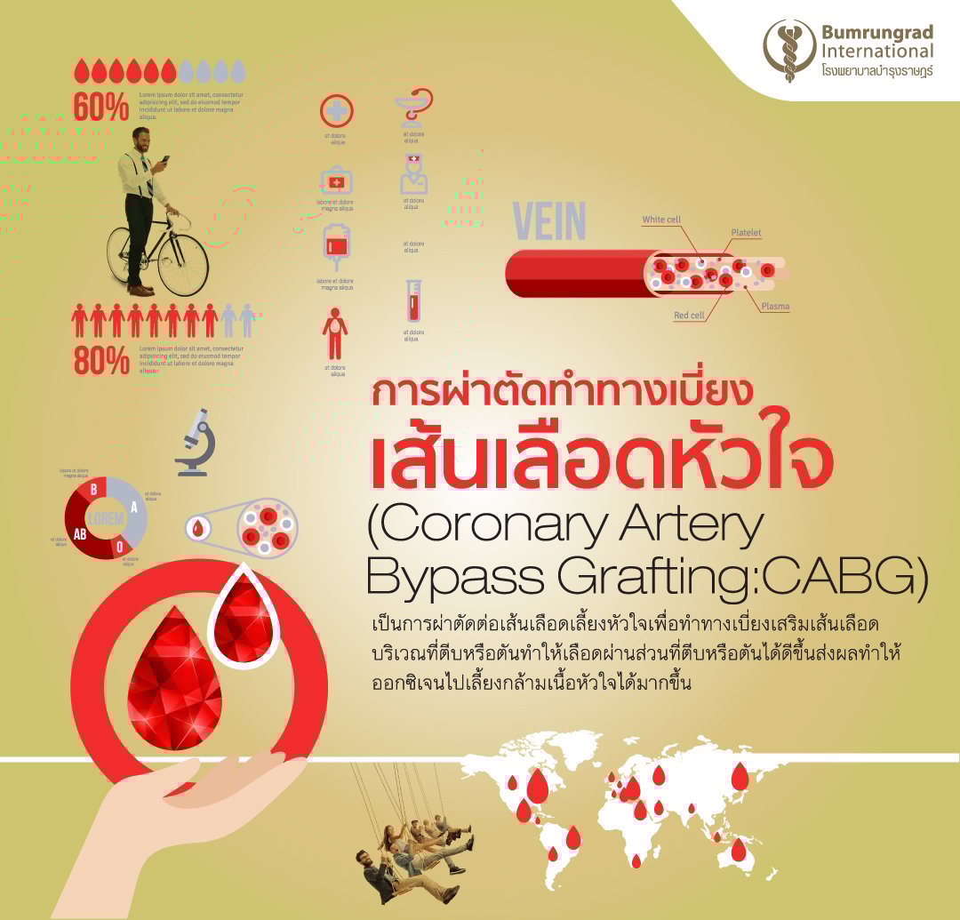 การผ่าตัดเบี่ยงเส้นเลือดหัวใจ บายพาสหัวใจ