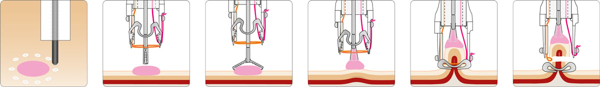 FTRD_ProcedureGrasper_wMarking_2019-05-09_allSteps.jpg