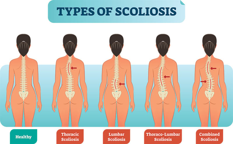 Sleeping With Scoliosis and Spinal Fusion