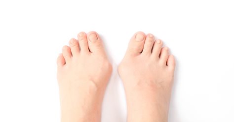 Bunions or Hallux Valgus