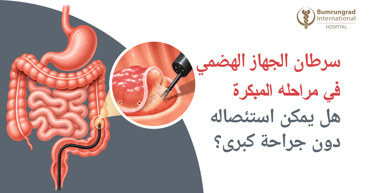 سرطان الجهاز الهضمي في مراحله المبكرة: هل يمكن استئصاله دون جراحة كبرى؟