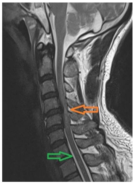 Cervical-Myelopathy_Case1.JPG