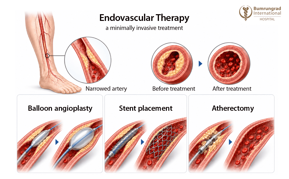 Endovascular-and-Surgical-Revascularization-for-Non-Healing-Wounds-image-1.png