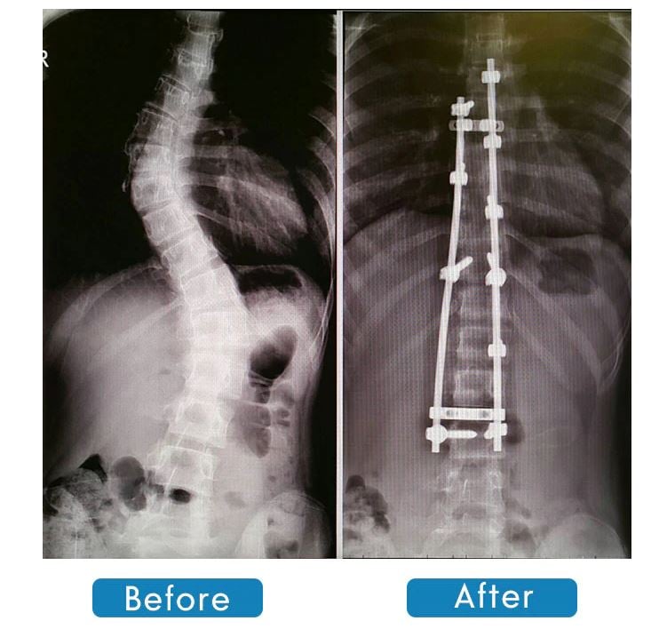 scoliosis_2.JPG