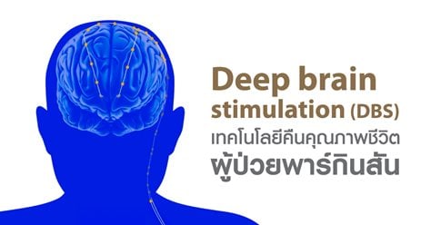 Deep brain stimulation (DBS) เทคโนโลยีคืนคุณภาพชีวิตผู้ป่วยพาร์กินสัน