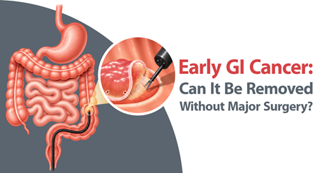 Early GI Cancer: Can It Be Removed Without Major Surgery
