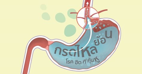 กรดไหลย้อน โรคฮิตที่คุ้นหู
