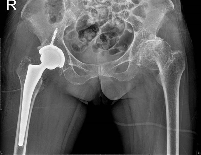 05_hip-osteoarthritis_670x517px.jpg