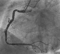 blocked coronary arteries