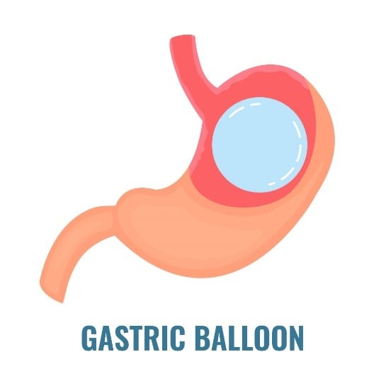 Gastric-balloon.jpg
