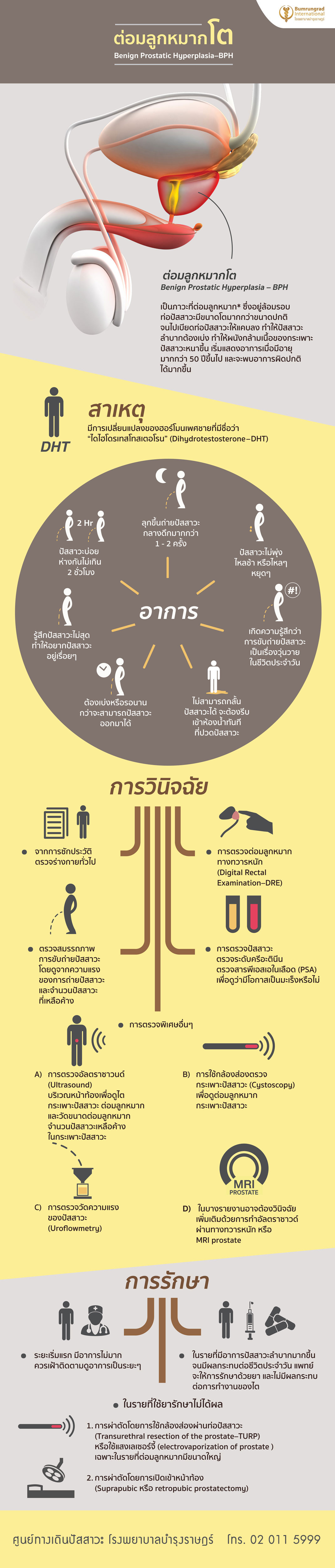 อาการ การรักษาโรคต่อมลูกหมากโต