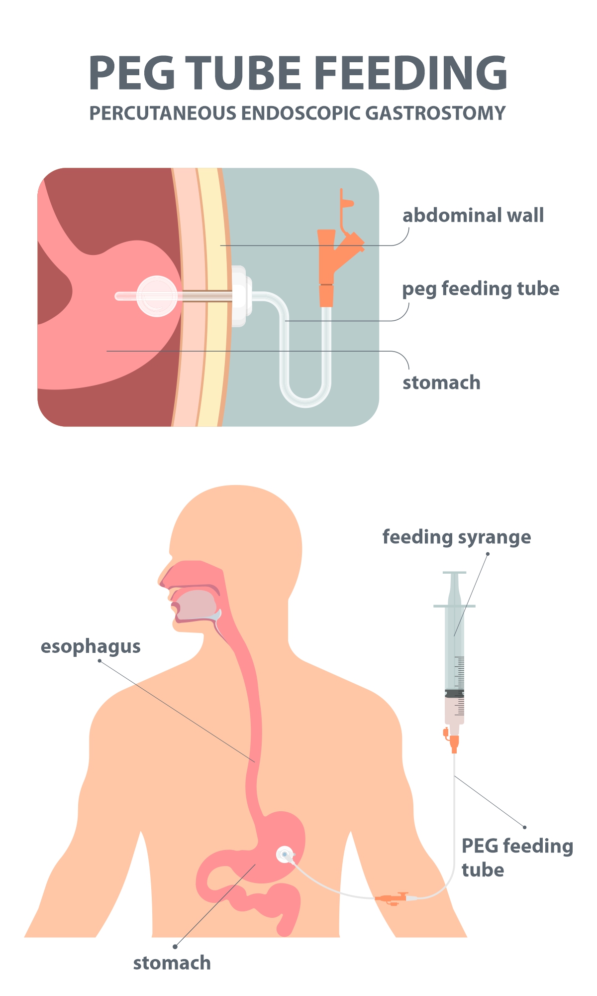 Gastrostomy Nutrition: A Patient’s Guide to the Latest American Guidelines