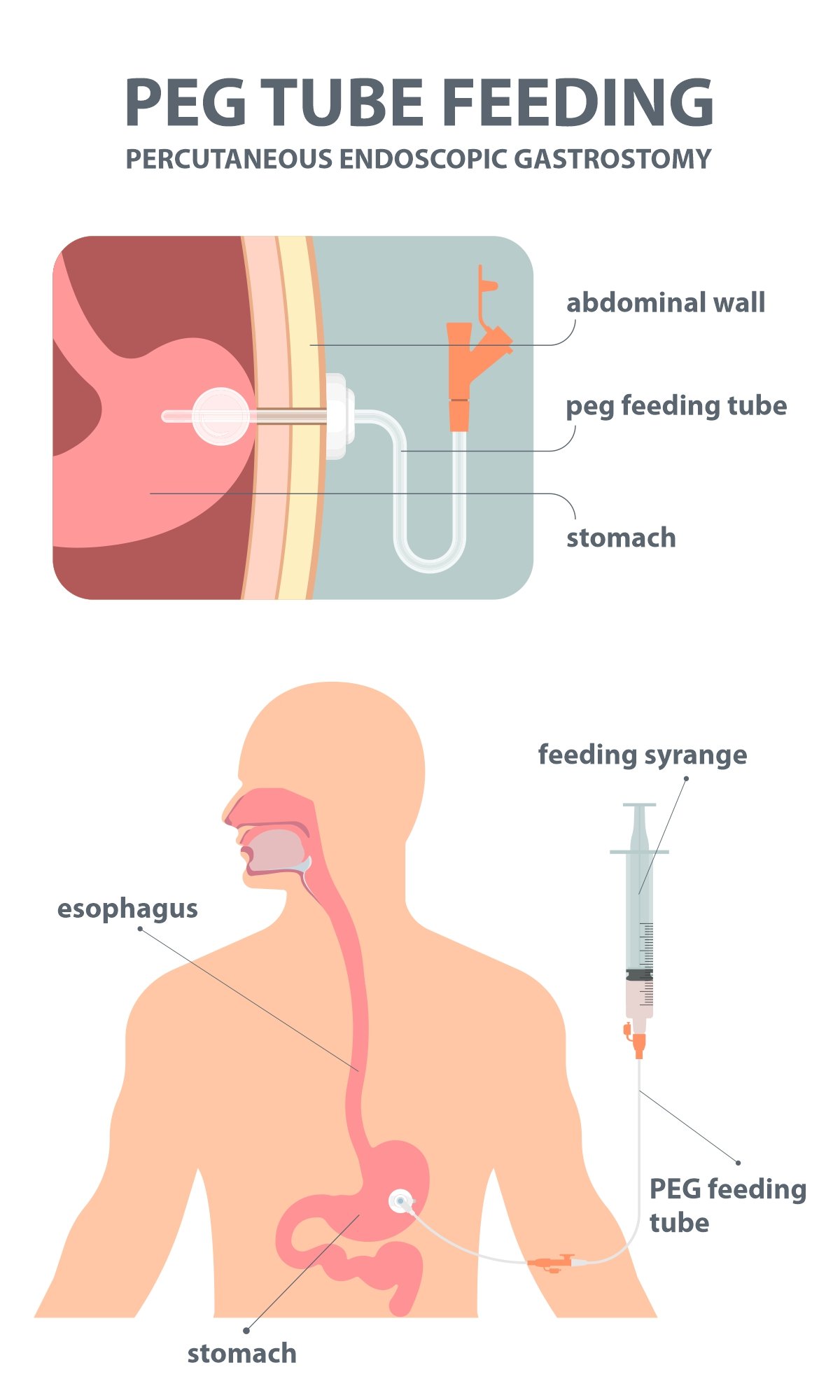 Gastrostomy Button Placement