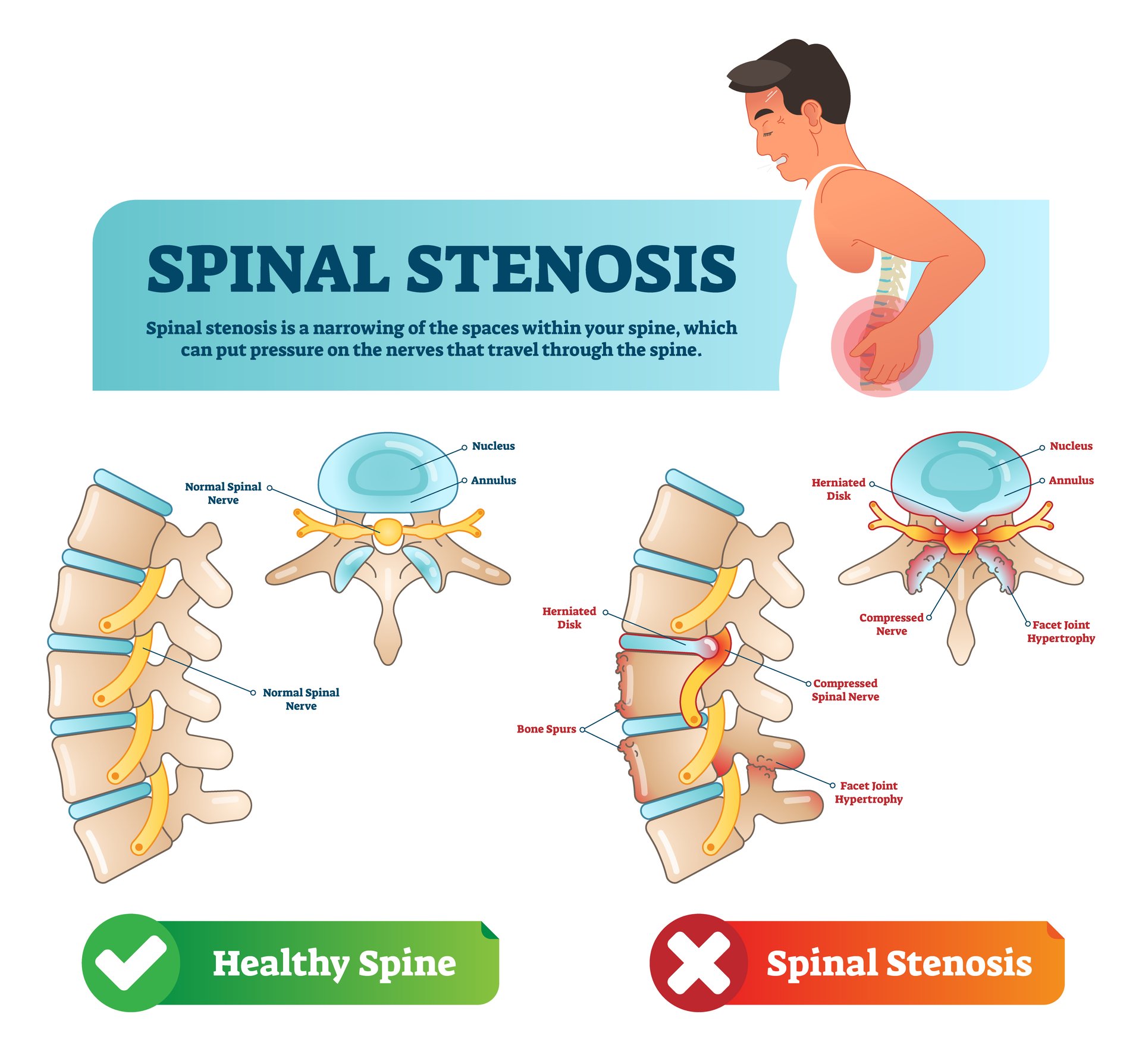 Lumbar-spinal-stenosis.jpg