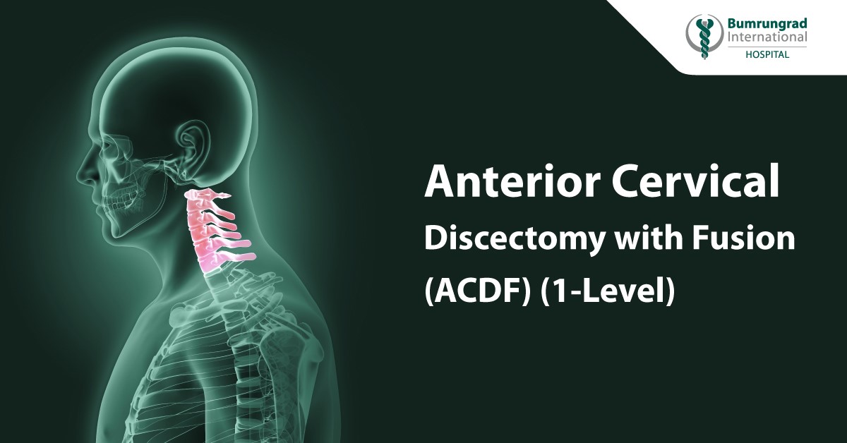 Anterior Cervical Discectomy with Fusion 1 Level (ACDF)