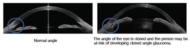 complete-eye-examination close angle glaucoma