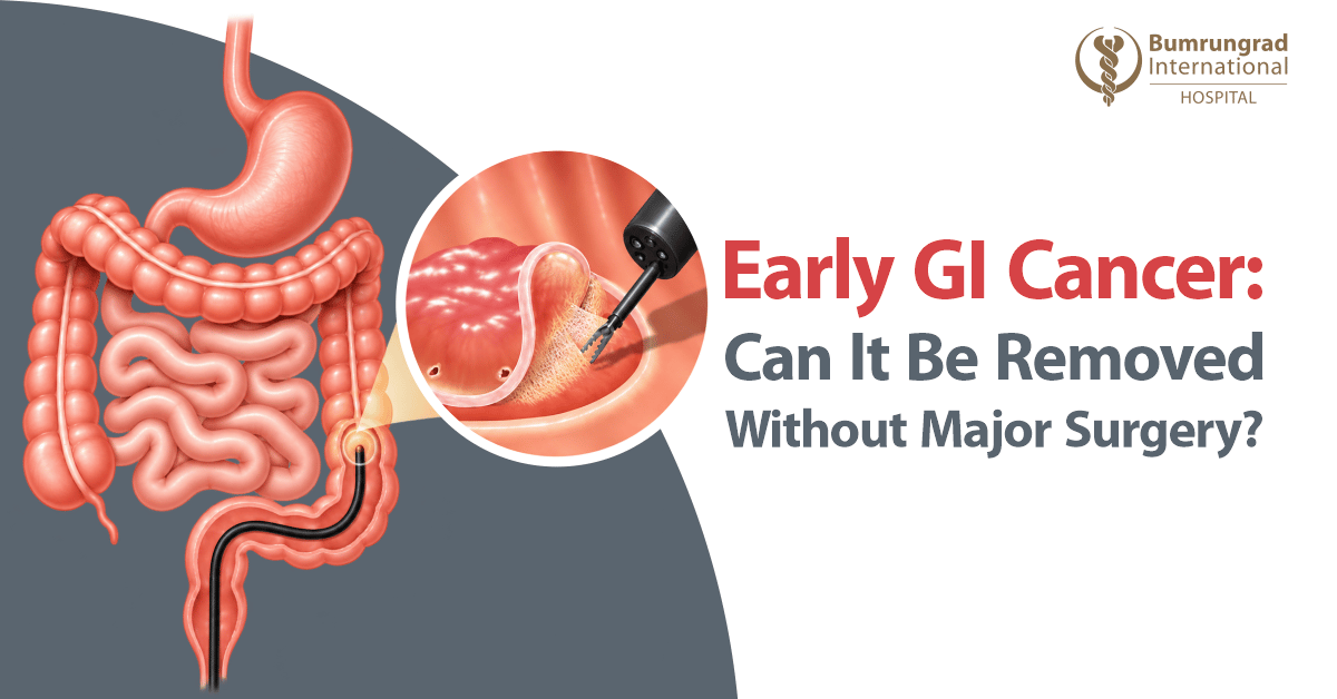 Early GI Cancer: Can It Be Removed Without Major Surgery
