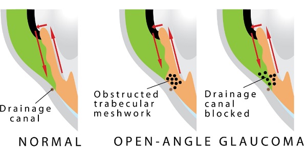 Open Angles Glaucoma - symptoms and treatment - Eye | Bumrungrad Hospital Thailand