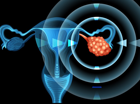 Ovarian Cancer symptoms and treatments