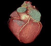 Coronary CTA scan