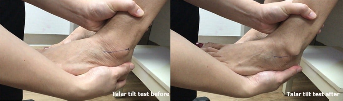 Ankle Orthopaedic Test: Talar tilt