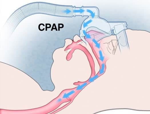 CPAP.jpg