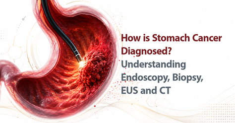 How Is Stomach Cancer Diagnosed? Understanding Endoscopy, Biopsy, EUS and CT