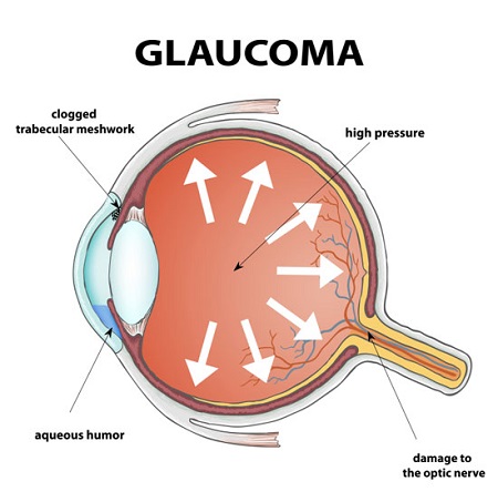Mechanism of Glaucoma