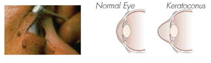 complete-eye-examination keratocunus
