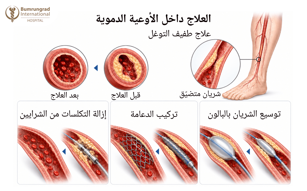 Endovascular-and-Surgical-Revascularization-for-Non-Healing-Wounds-image-1-AR.png