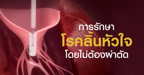การรักษาโรคลิ้นหัวใจโดยไม่ต้องผ่าตัด