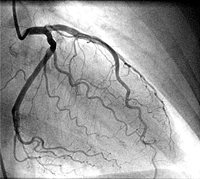 Coronary Angiography (CAG)