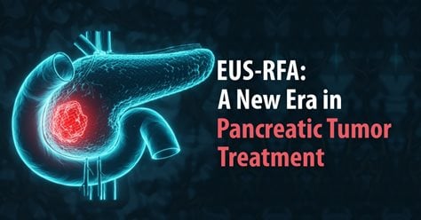 EUS-RFA: A New Era in Pancreatic Tumor Treatment