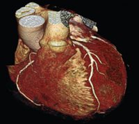Coronary Computed Tomographic Angiography