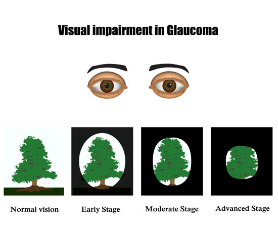 Symptoms and process of glaucoma