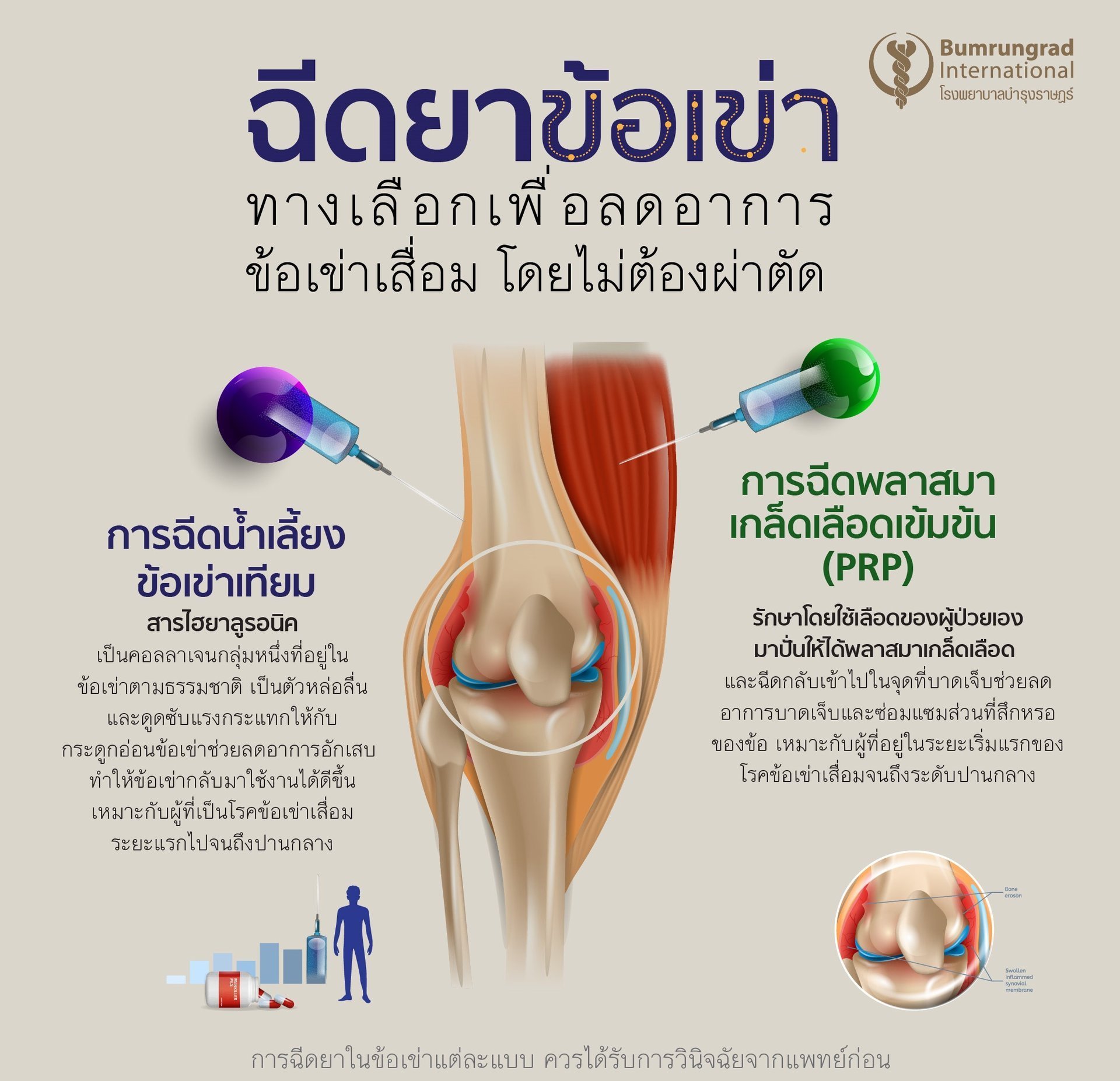 การรักษาโรคข้อเข่าเสื่อมด้วยการฉีดยาข้อเข่า