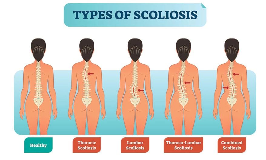 scoliosis_1.JPG