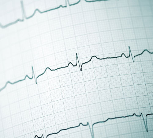 The-Watchman-Device-for-Atrial-Fibrillation-500x450.jpg