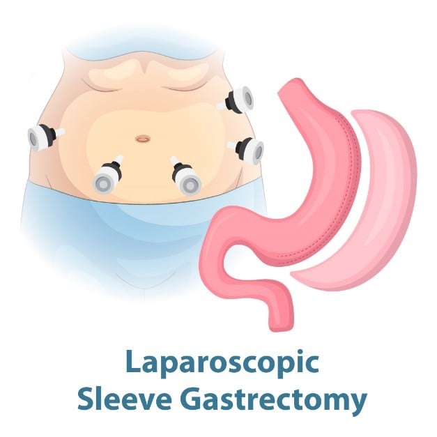 Laparoscopic-sleeve-gastroplasty.jpg