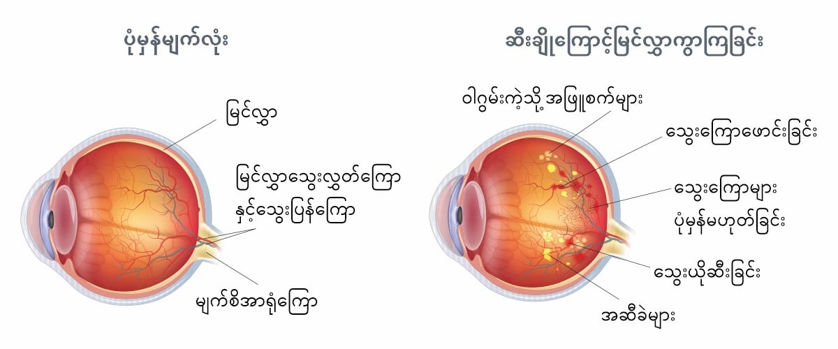 Diabetic-retinopathy-MM-New-1.jpg