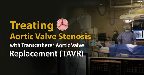 Treating Aortic Valve Stenosis with Transcatheter Aortic Valve Replacement (TAVR)