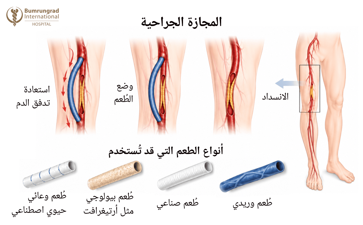 Endovascular-and-Surgical-Revascularization-for-Non-Healing-Wounds-image-2-AR.png