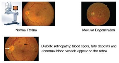 complete-eye-examination-Diabetic retinopathy