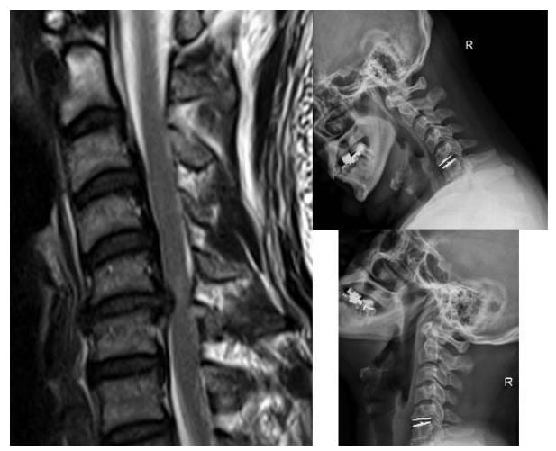 Cervical-Myelopathy_Case2.JPG