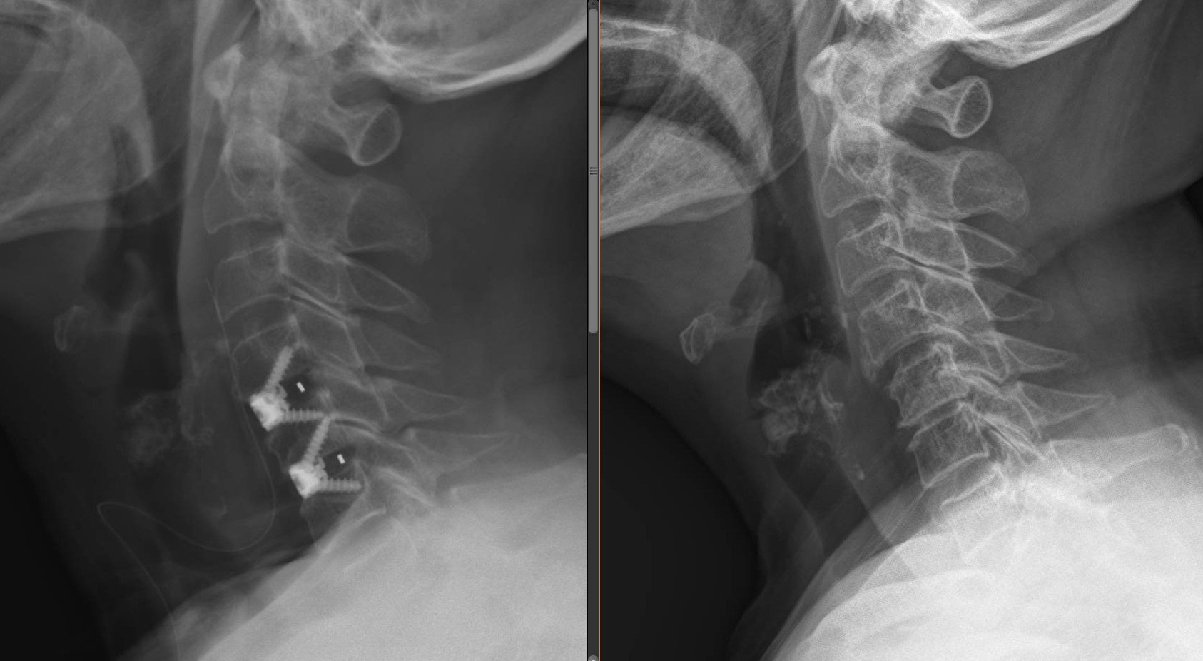 Pic1_Cervical-Fusion.jpg