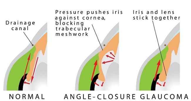 Angle-closure glaucoma